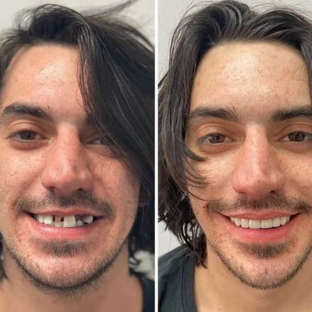 DentiFix™ | Obtenez un sourire fort, sûr et sans souci toute la journée